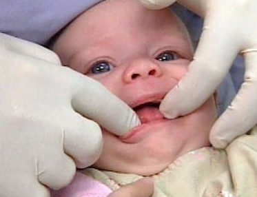 Bebeklerde diş çıkarma