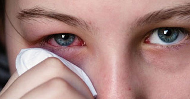 Göz kanlanması neden olur, nasıl geçer? Tedavisi ve öneriler