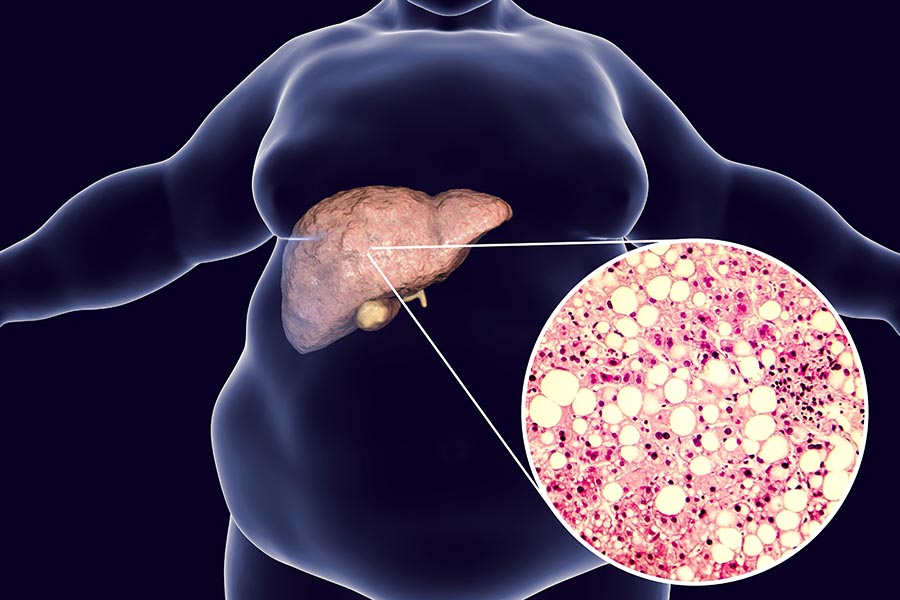 Karaciğer Yağlanması Nedir? Belirtileri & Tedavisi