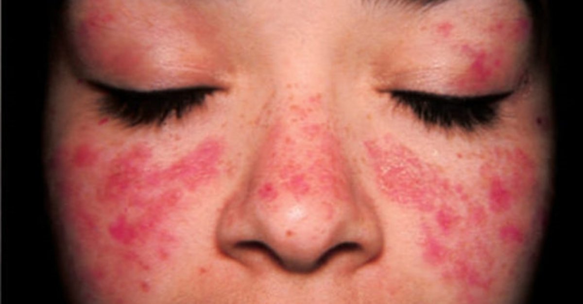 Kelebek hastalığı (Lupus) nedir?