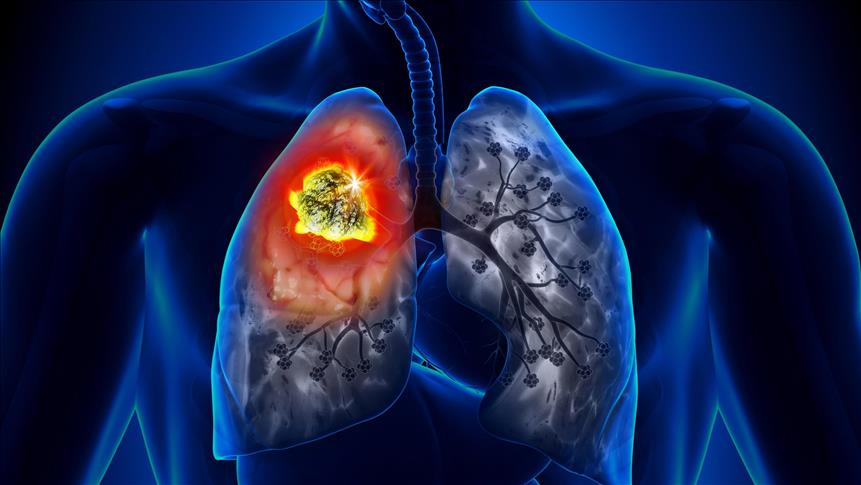 Ailesinde Akciğer Kanseri Olanlar İçin Risk 2.4 Kat Daha Fazla