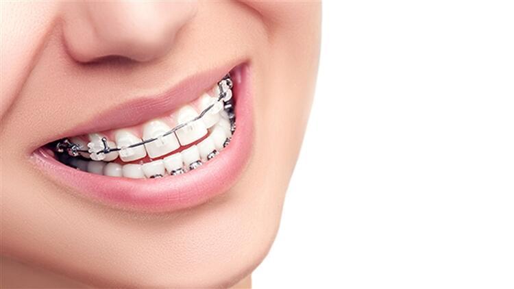 Diş Teli Tedavisi Hakkında Doğru Bilinen Yanlışlar