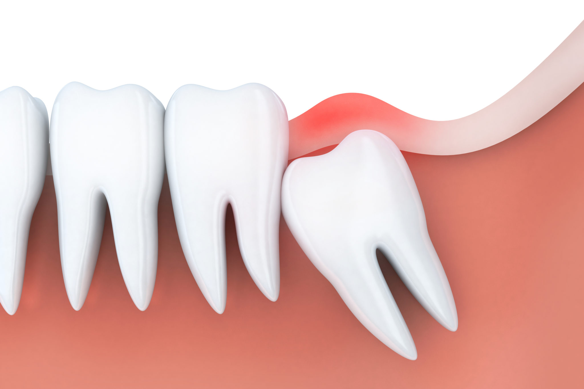 Yirmilik Diş Nedir? 20’lik Diş Çekimi Nasıl Olur?