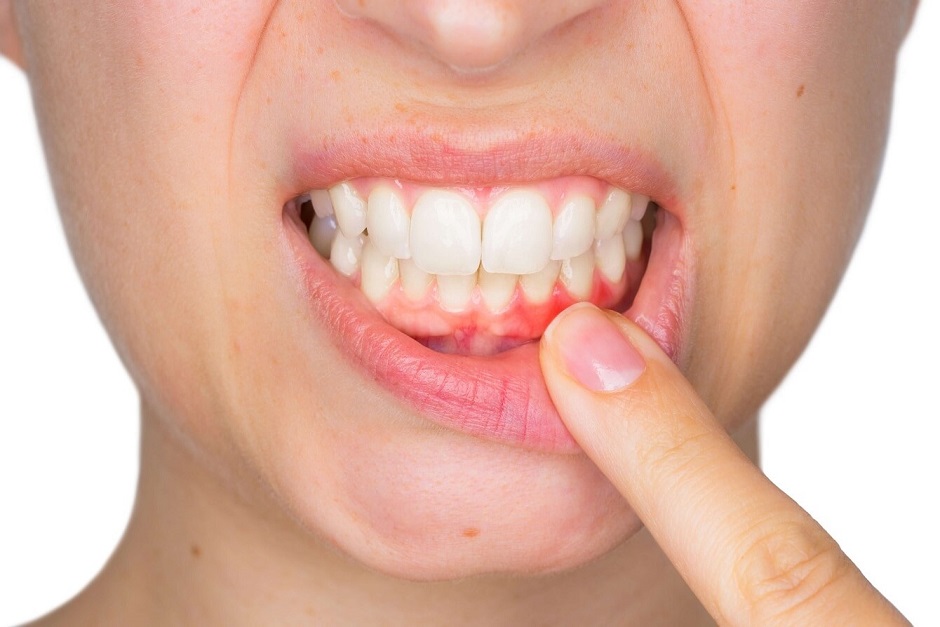 Diş Eti Çekilmesi (Periodontitis)