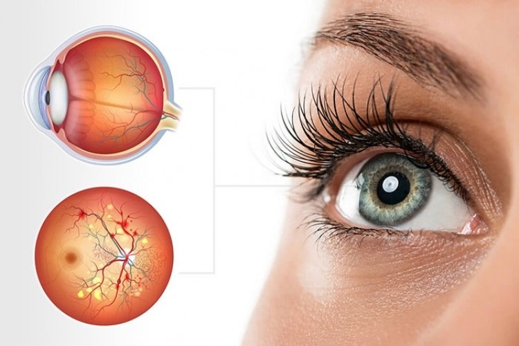 Retina Hastalıkları Nelerdir?