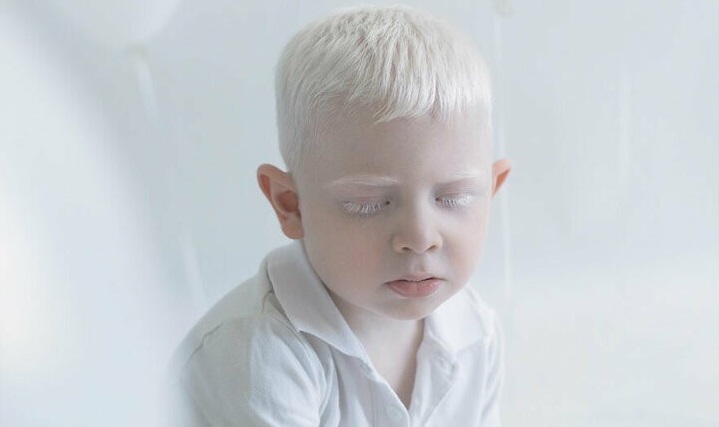 Albino (Albinizm) Nedir? Belirtileri Nelerdir?
