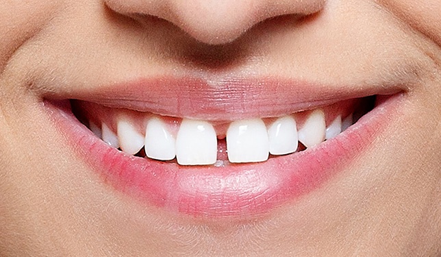 Diş Taşı Nedir? Diş Taşı Tedavisi