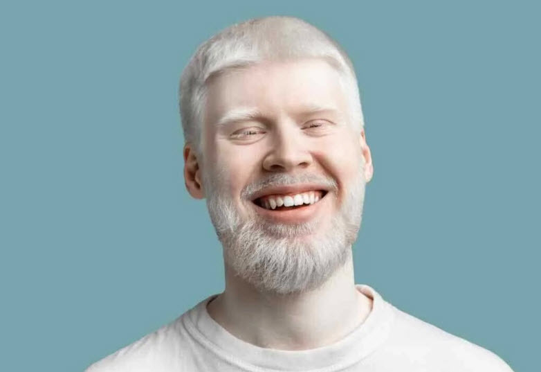 Albinizm (Albino) nedir? Tedavisi var mıdır?