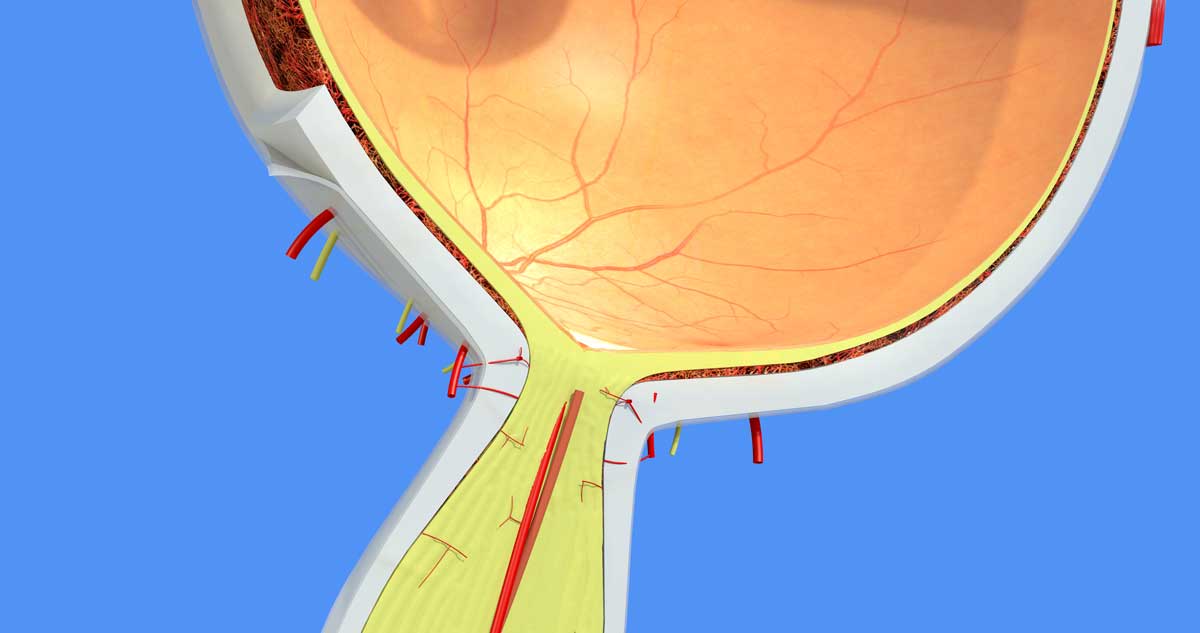 Papilödem (Optik sinir şişmesi) nedir?