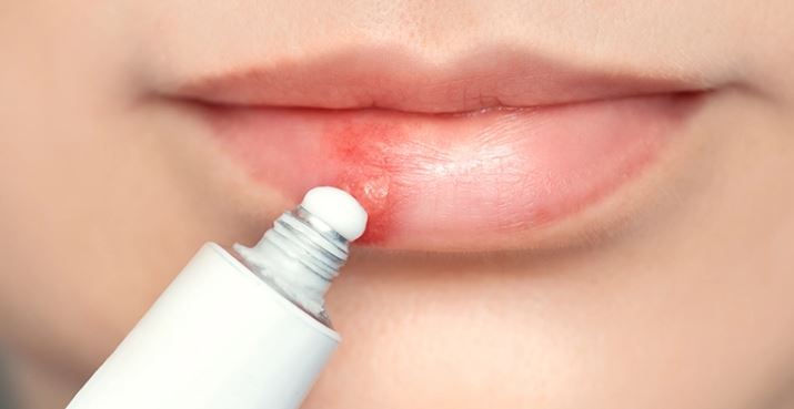 Uçuk (Herpes Simplex) Nedir?