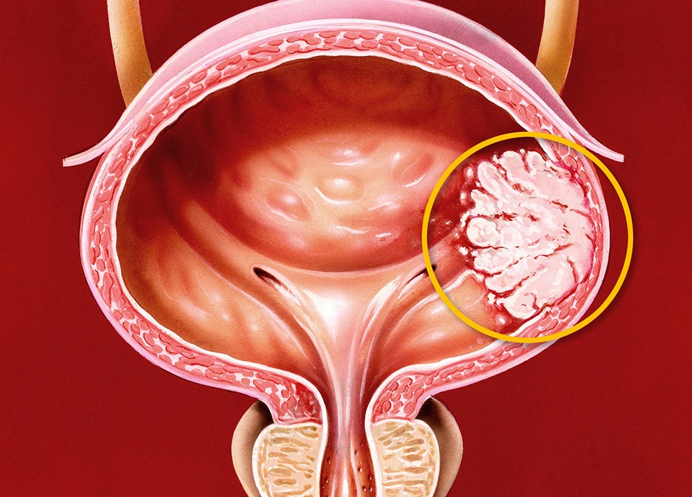 Mesane Kanseri Belirtileri, Evreleri ve Tedavisi