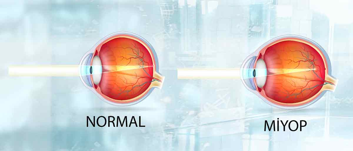Miyop Nedir? Miyop Belirtileri, Nedenleri ve Tedavisi