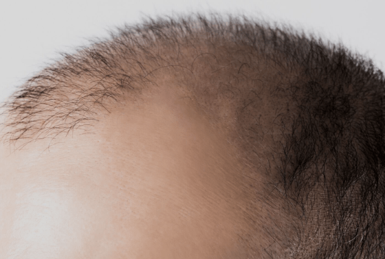 Ergenlikte Saç Dökülmesi